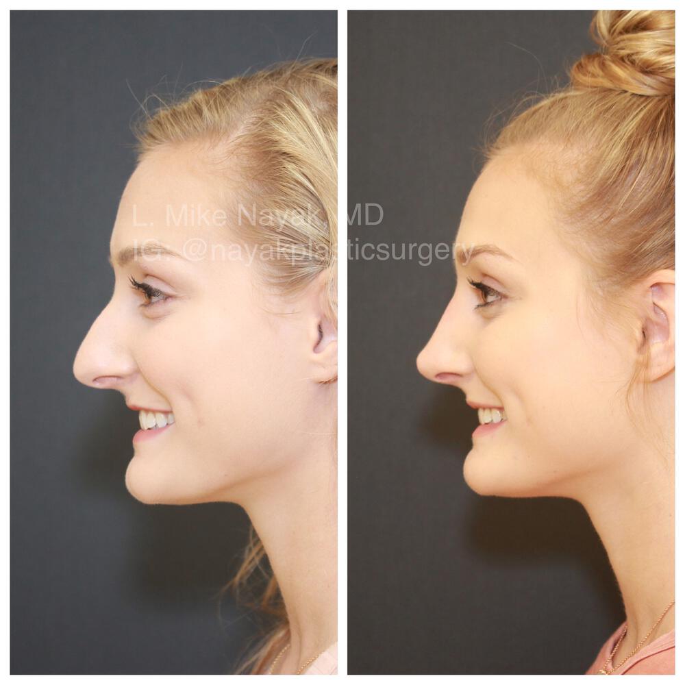 Rhinoplasty Before & After Image