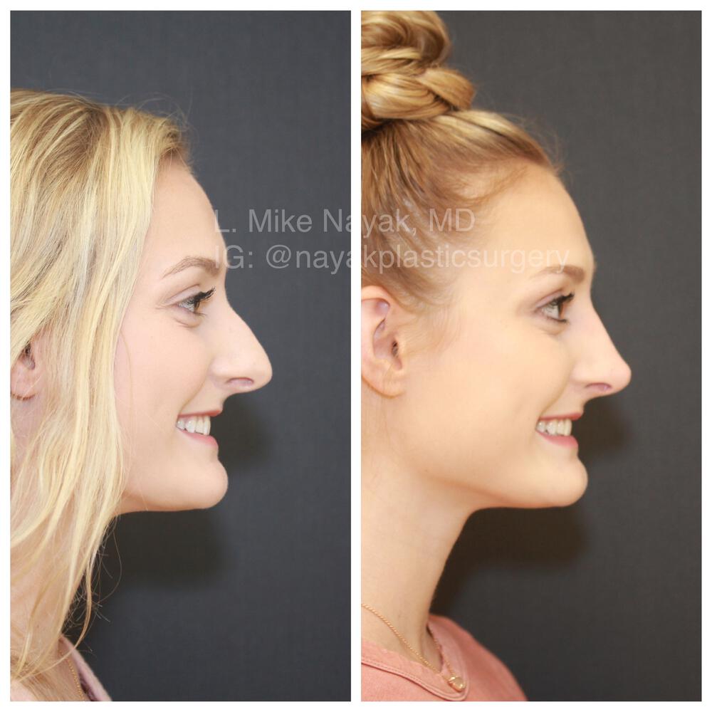 Rhinoplasty Before & After Image