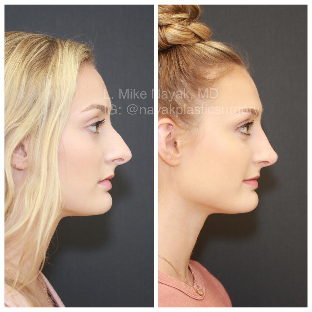 Rhinoplasty Before & After Image