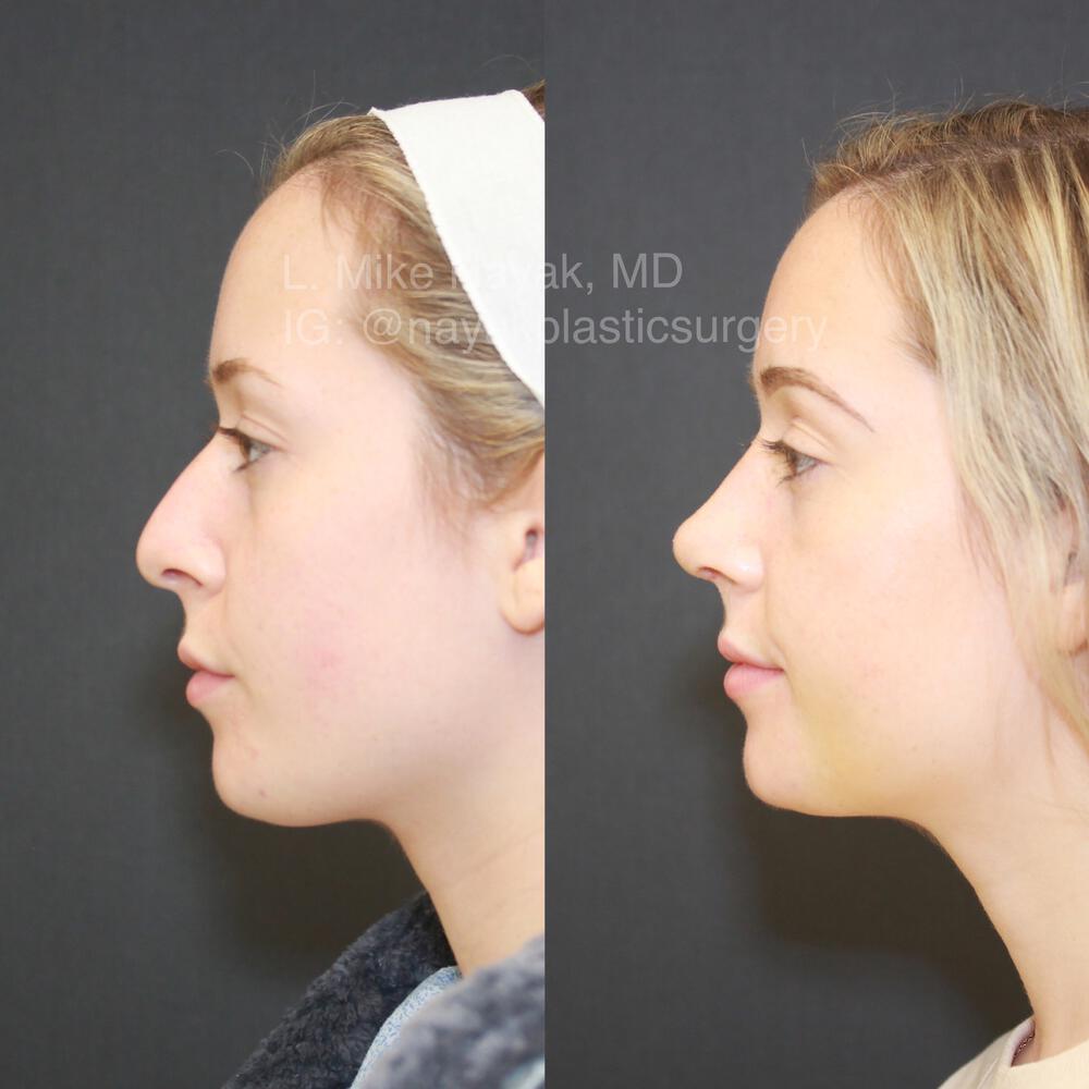 Rhinoplasty Before & After Image