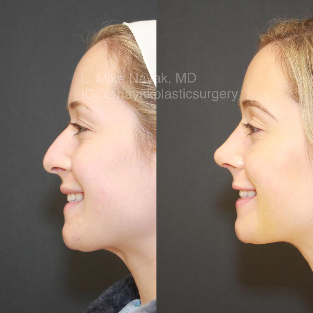 Rhinoplasty Before & After Image