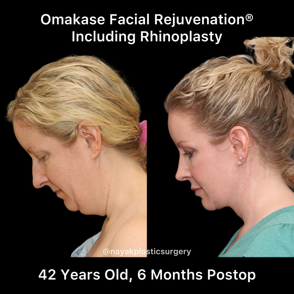 Rhinoplasty Before & After Image