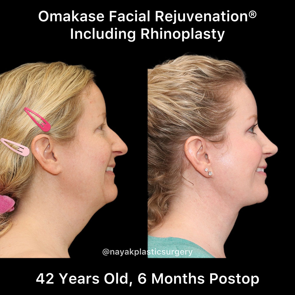 Rhinoplasty Before & After Image