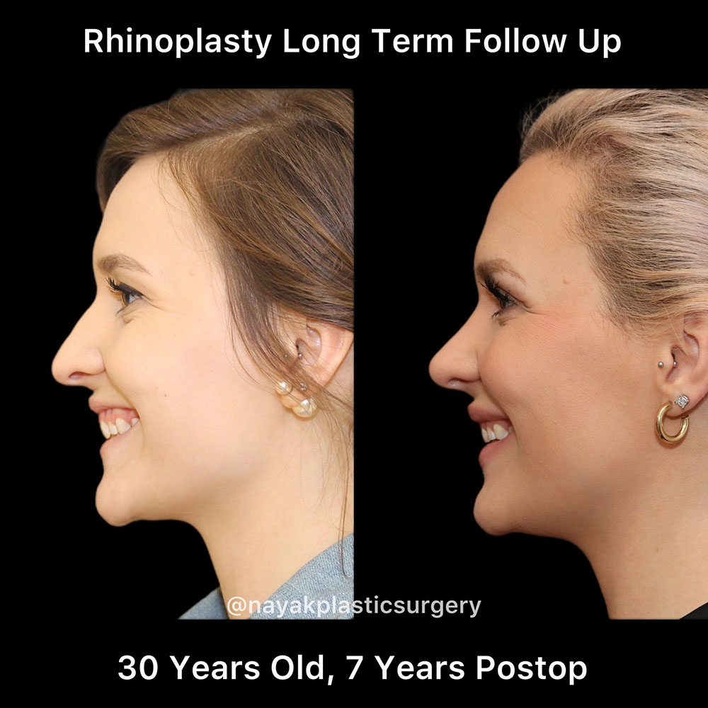 Rhinoplasty Before & After Image