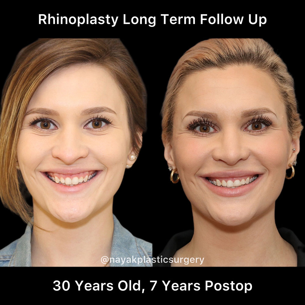 Rhinoplasty Before & After Image