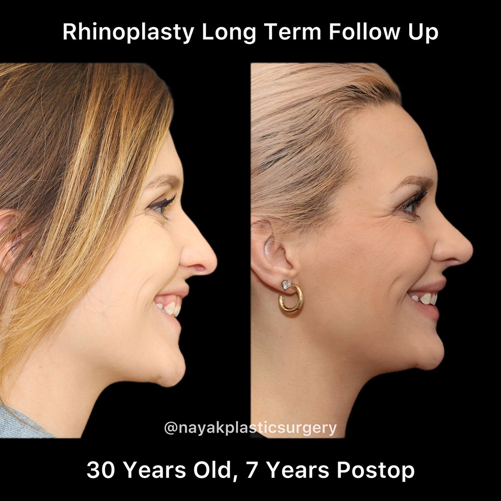 Rhinoplasty Before & After Image