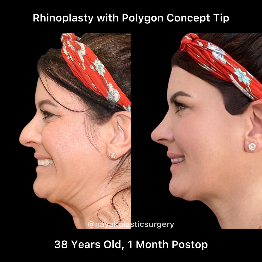 Rhinoplasty Before & After Image