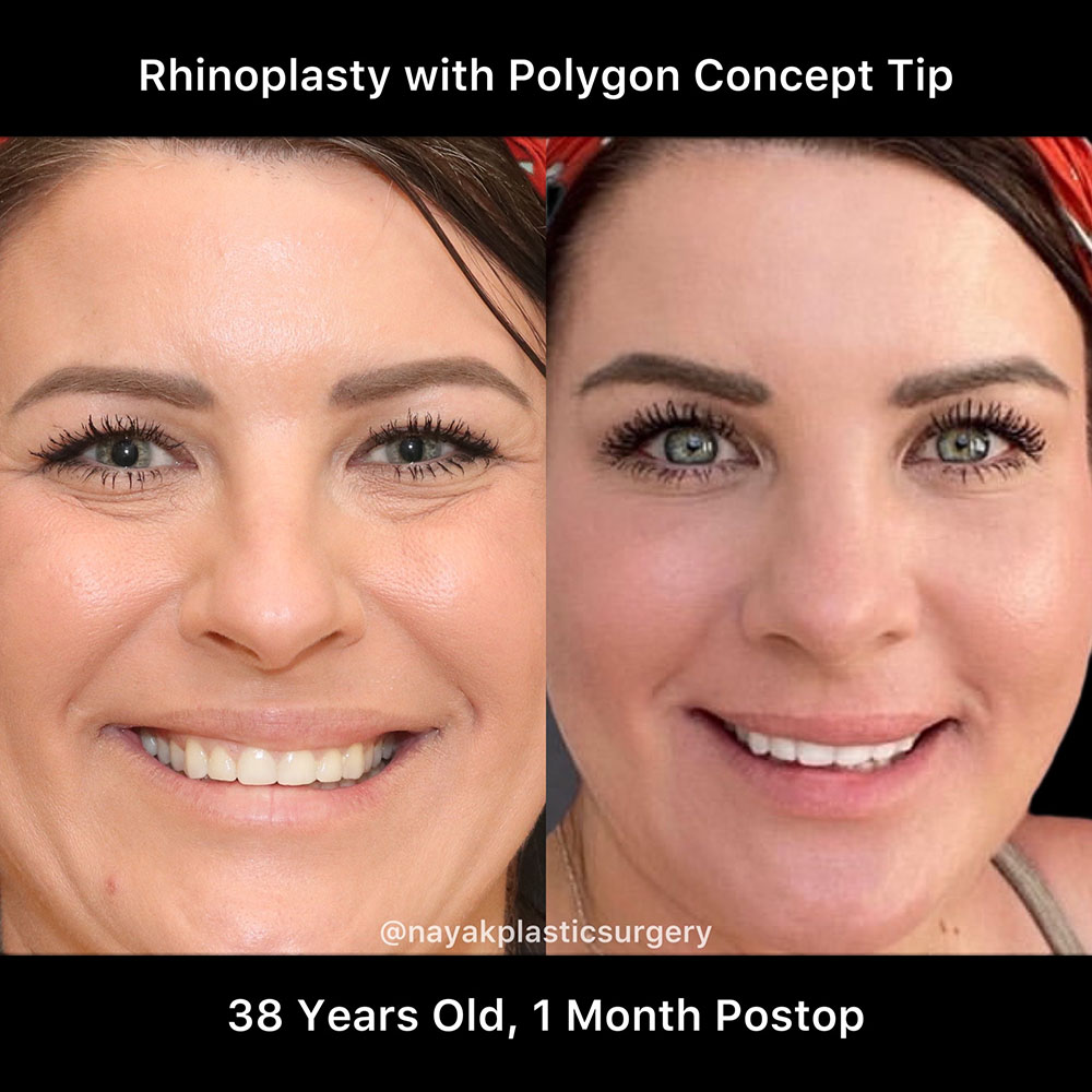 Rhinoplasty Before & After Image