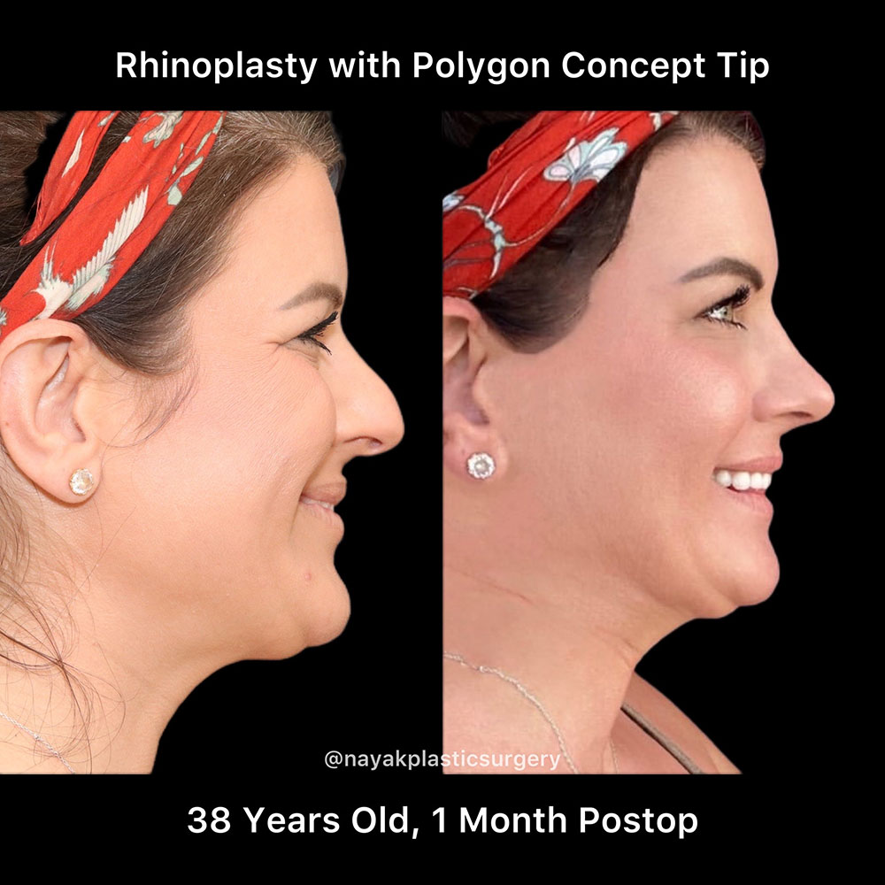 Rhinoplasty Before & After Image