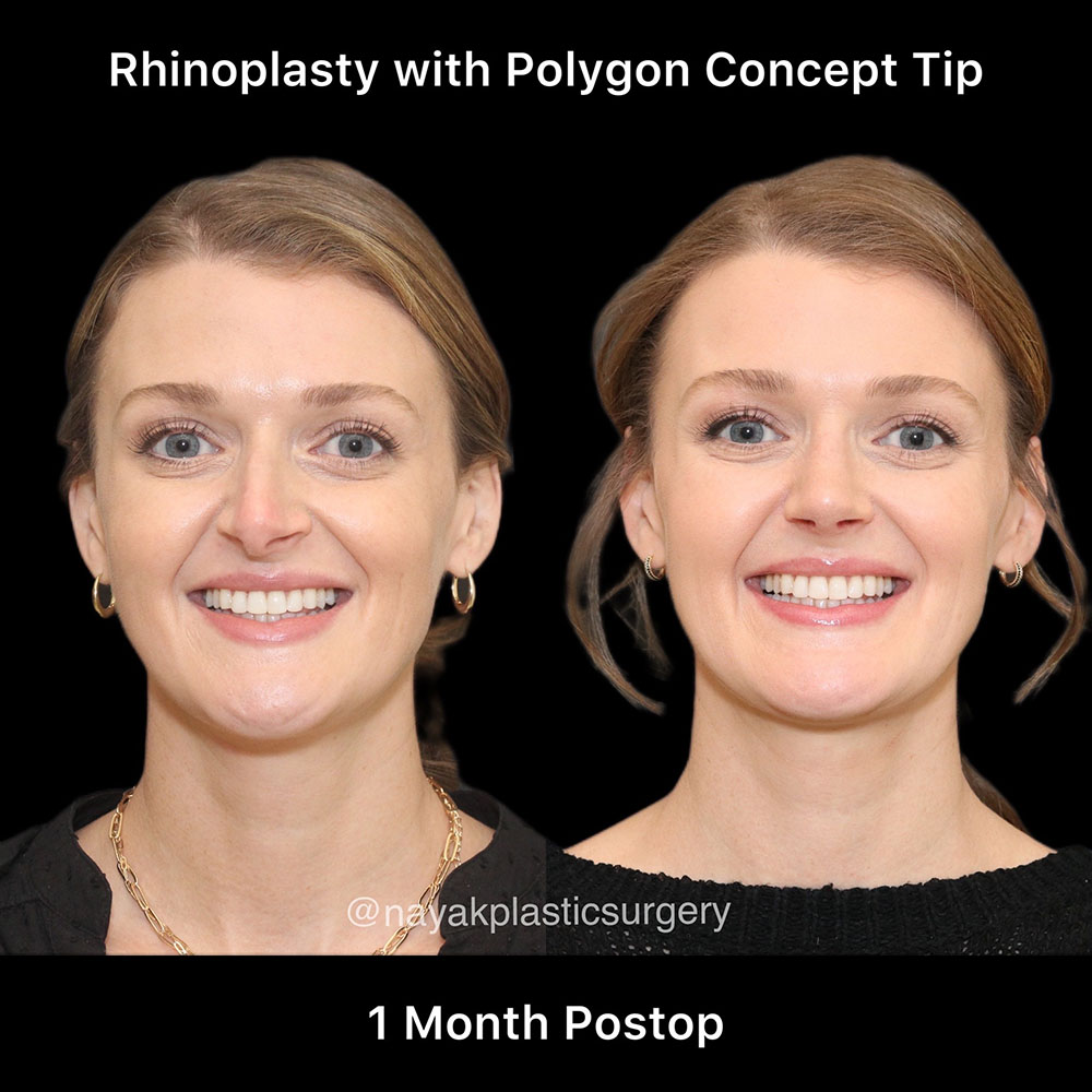 Rhinoplasty Before & After Image