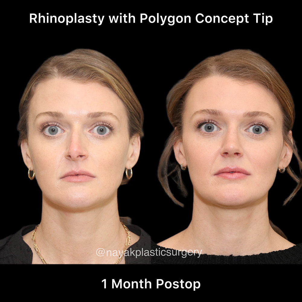 Rhinoplasty Before & After Image