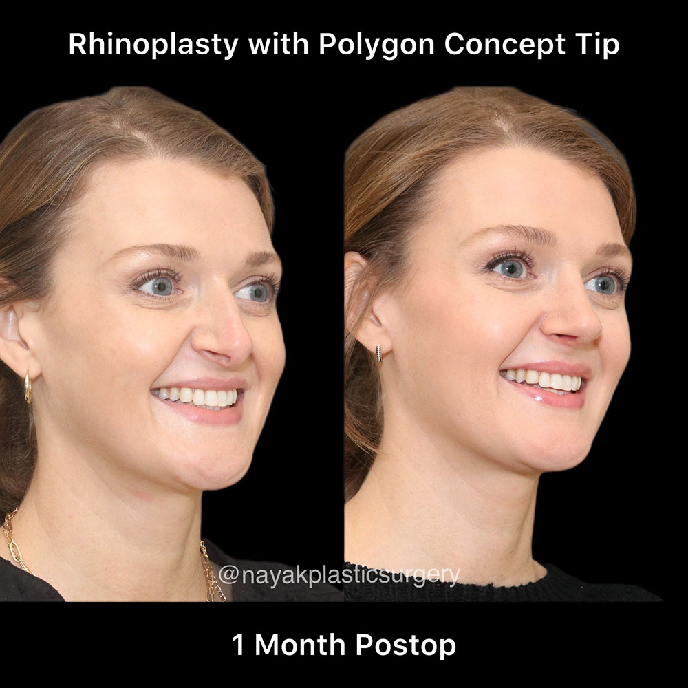 Rhinoplasty Before & After Image