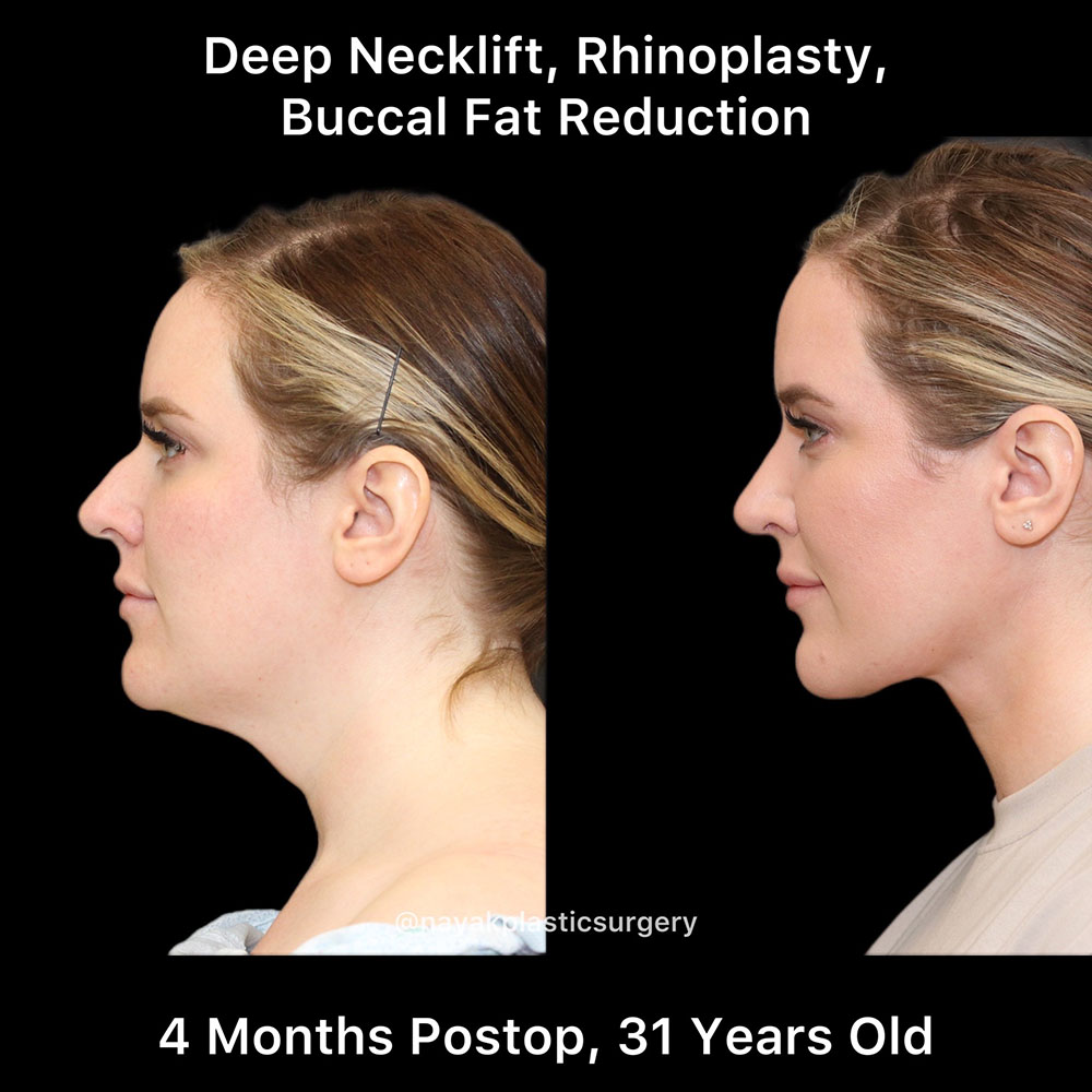 Rhinoplasty Before & After Image