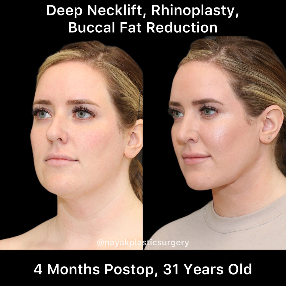 Rhinoplasty Before & After Image