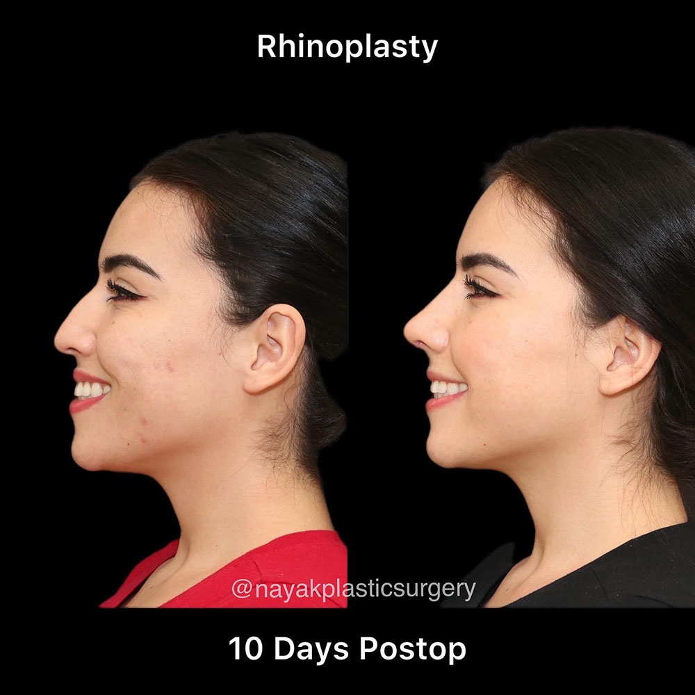 Rhinoplasty Before & After Image