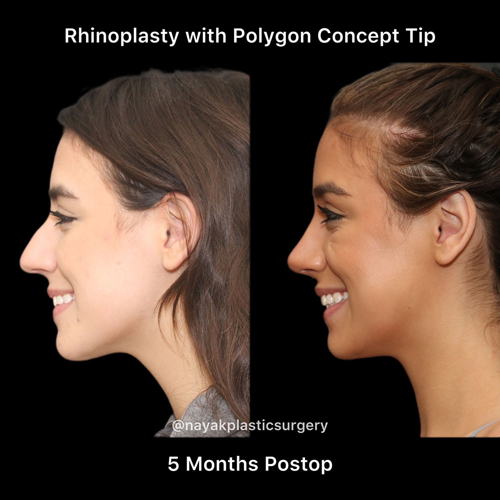 Rhinoplasty Before & After Image