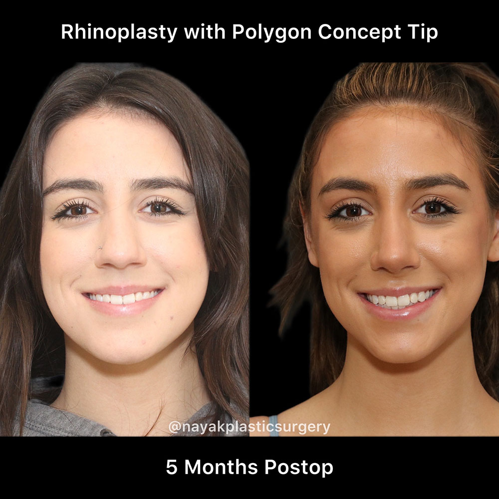 Rhinoplasty Before & After Image