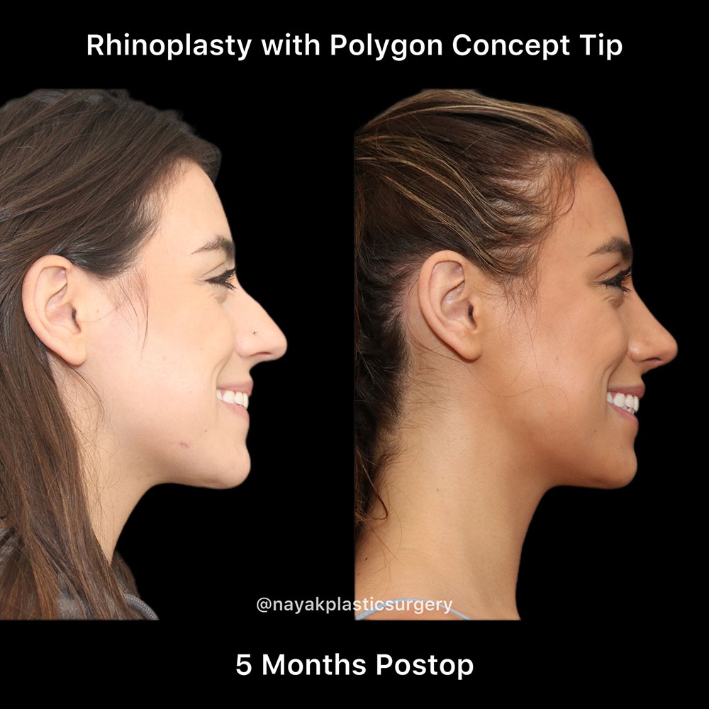 Rhinoplasty Before & After Image