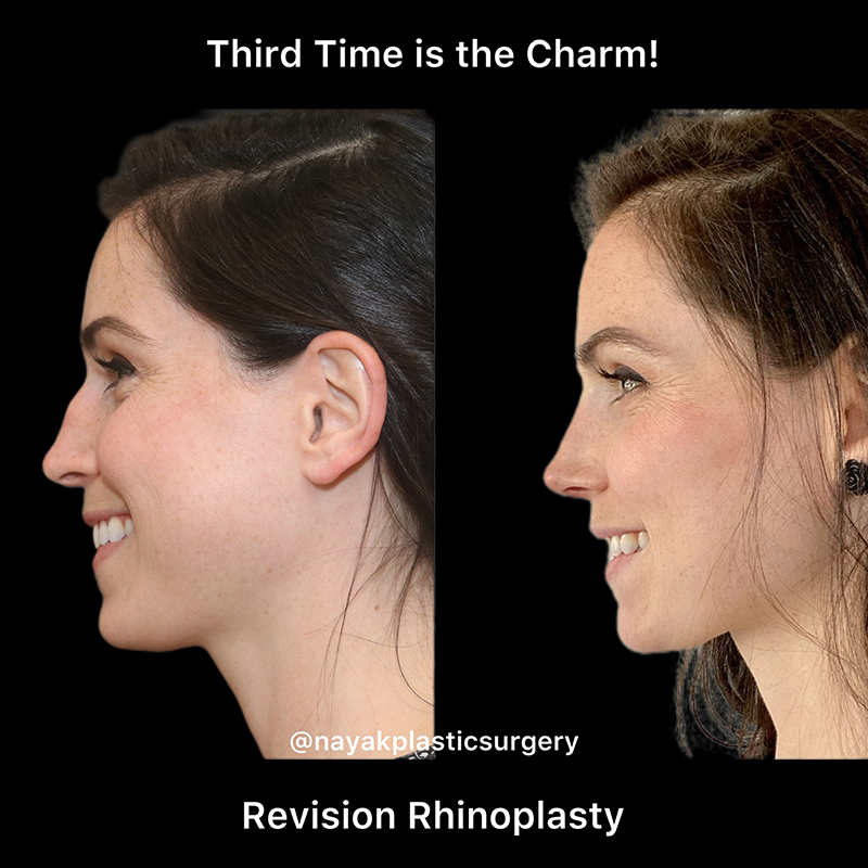 Rhinoplasty Before & After Image