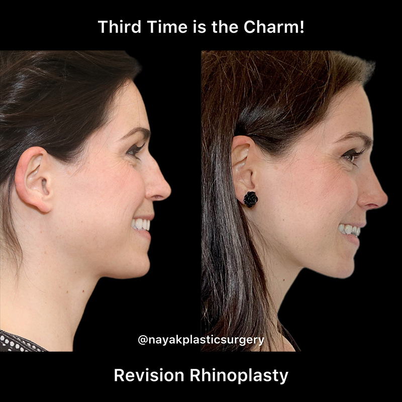 Rhinoplasty Before & After Image