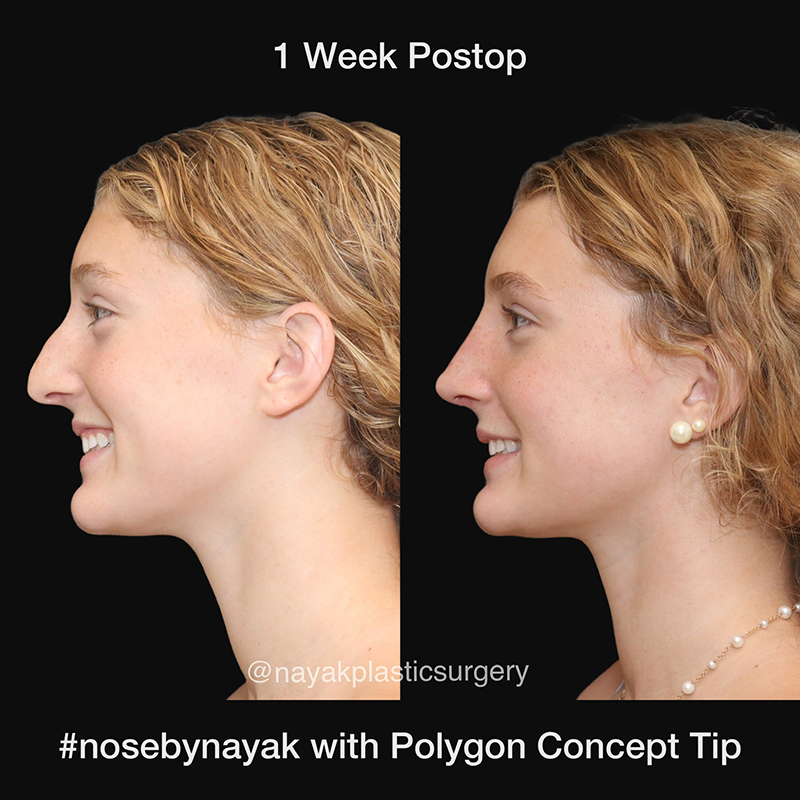 Rhinoplasty Before & After Image