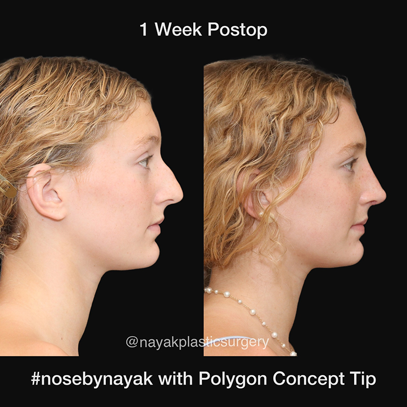 Rhinoplasty Before & After Image