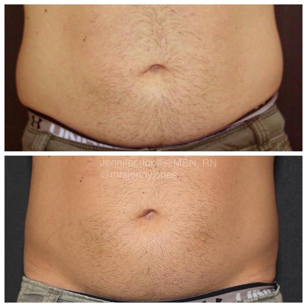 CoolSculpting Before & After Image