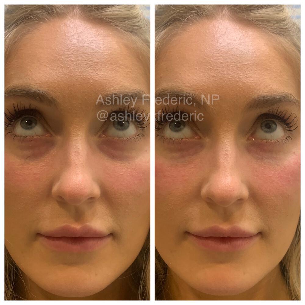 Tear Trough Filler Before & After Image