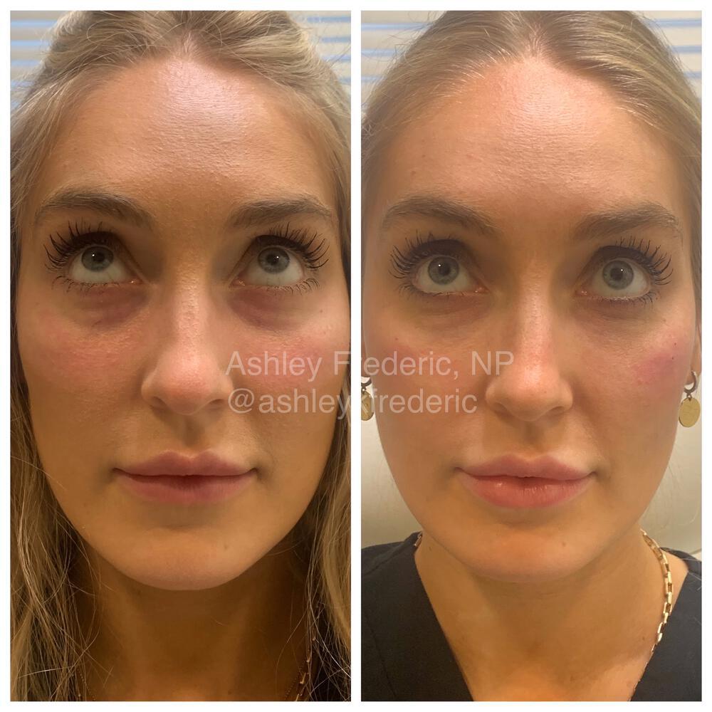 Tear Trough Filler Before & After Image