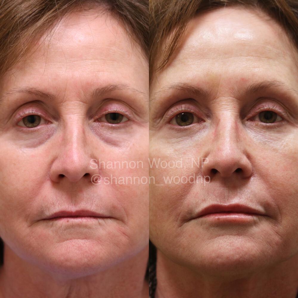 Tear Trough Filler Before & After Image