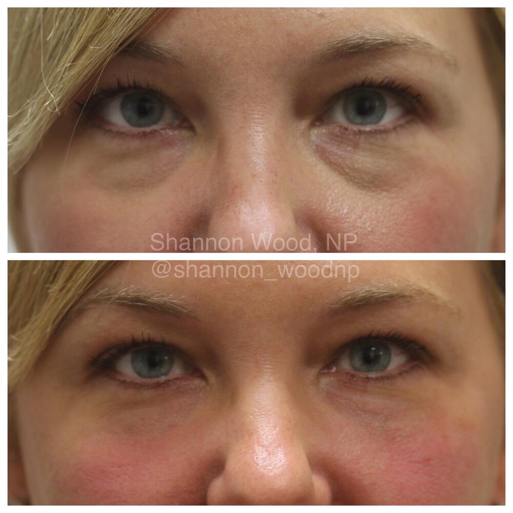 Tear Trough Filler Before & After Image