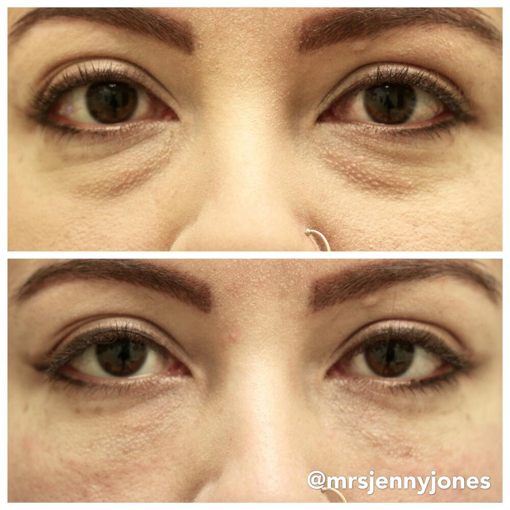 Tear Trough Filler Before & After Image