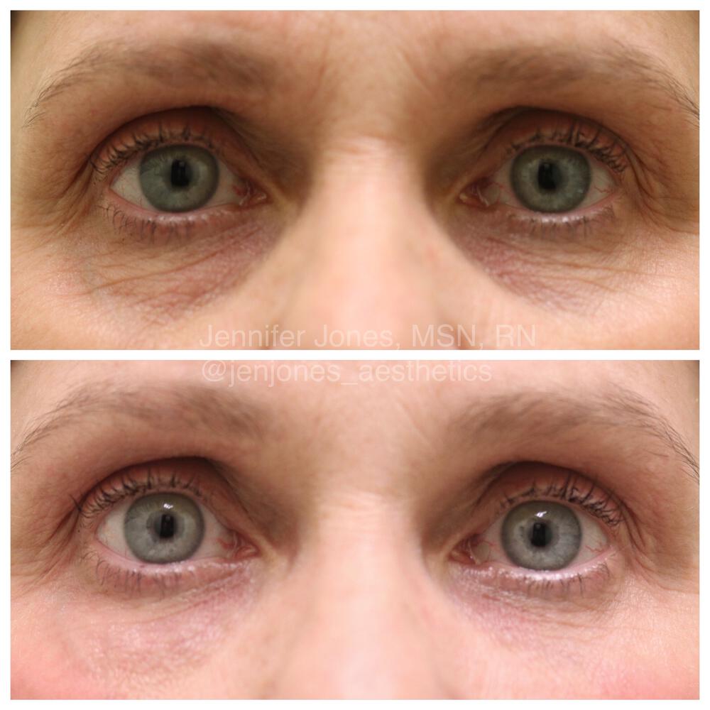 Tear Trough Filler Before & After Image