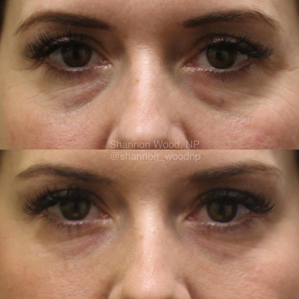 Tear Trough Filler Before & After Image