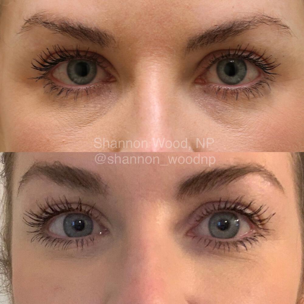 Tear Trough Filler Before & After Image