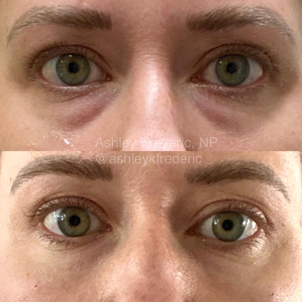 Tear Trough Filler Before & After Image